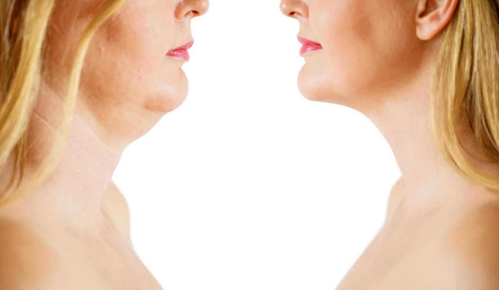 Double Chin treatment Andover before and after results