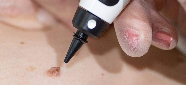 After Skin Tag Removal Andover