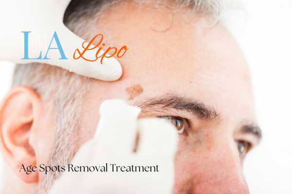 What Are the Most Effective Treatments for Age Spots Andover?