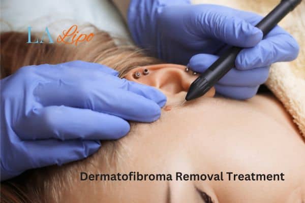 Dermatofibroma Removal Treatment Andover