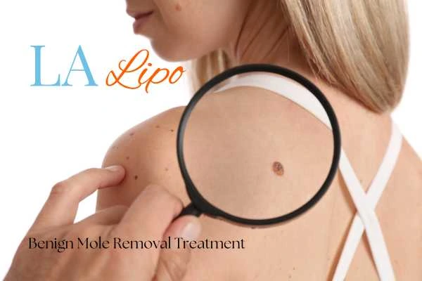 Why getting moles removed Andover can boost your confidence!