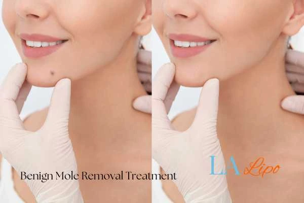 woman's before and after mole removal Andover results
