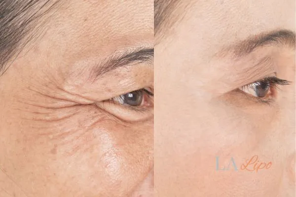 Before and after results of woman - HI-fu wrinkles reduction treatment Andover