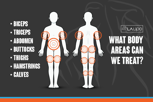 Graphic to show areas you can have LA-EMS Body Sculpting Andover treatment.