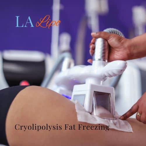 fat freezing - Cryolipolysis Andover