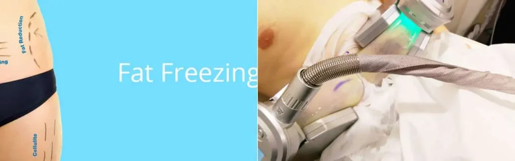 multi areas of a persons body having coolsculpting Andover treatment