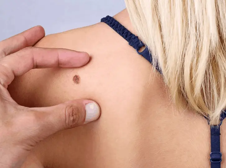 woman having mole removal Andover consultation before treatment.