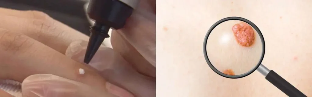 Cryopen for mole removal Andover - speak to our team today!