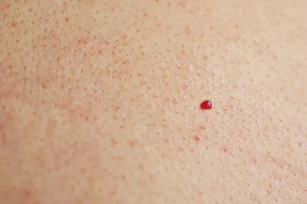 close up of a cherry angioma Andover