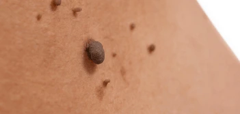 image of a skin tag Andover