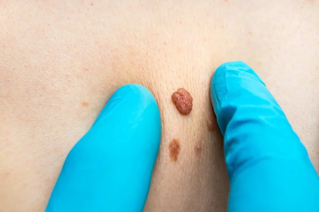 Consultant examining a skin tag Andover