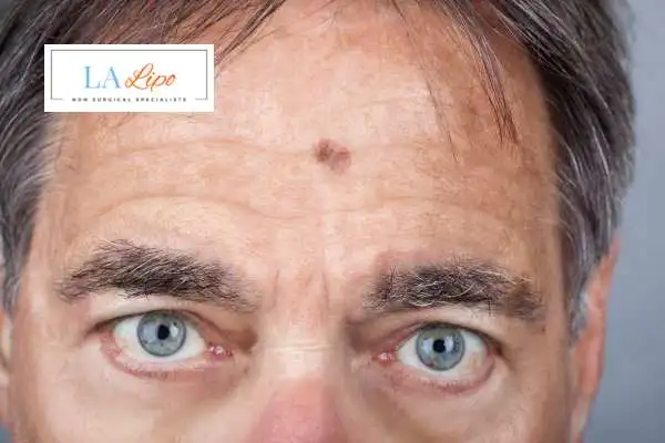 Solar Lentigo Removal Andover image of man with mark on his forehead