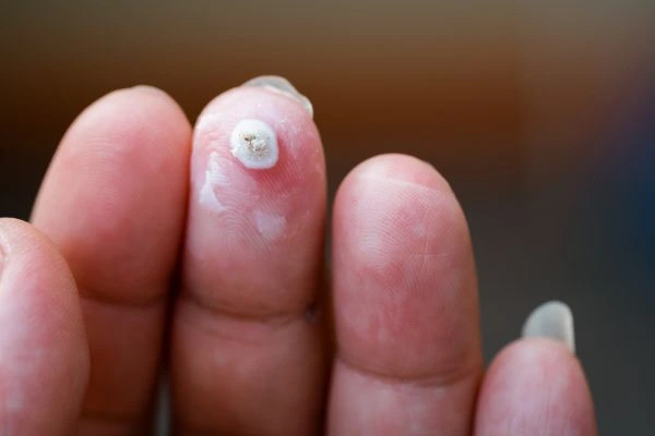 wart on person finger - cryotherapy to treat from LA LIPO Andover