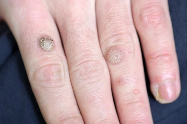 photo of warts on person hand - see wart removal Andover from LA LIPO