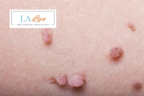 Does cryopen skin tag removal Andover hurt? Find out now call our team today!