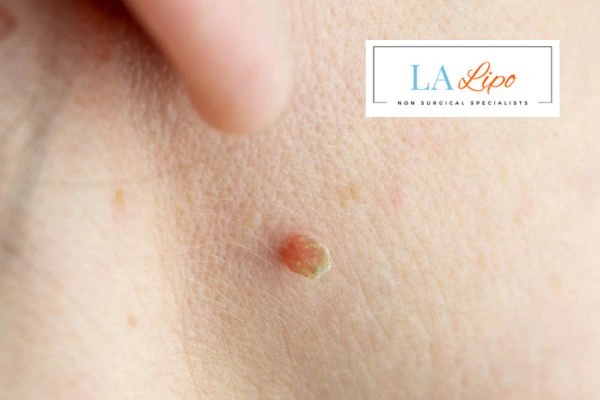 Book skin tag removal Andover today speak to our team now!