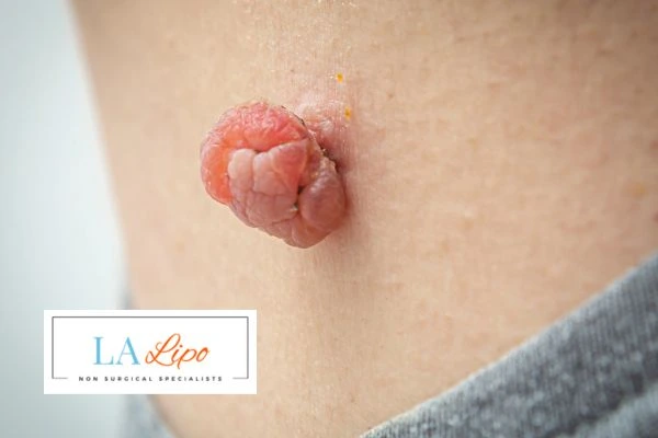 Interested in skin tag removal Andover? Concerned about the pain? Find out more today!