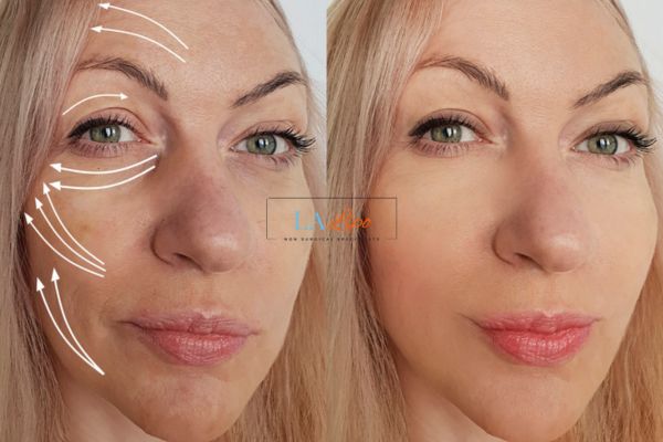 Morpheus 8 results Andover face lift.