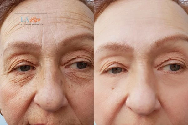 The powerful benefits of Morpheus8 Treatment Andover - Call Our team today!
