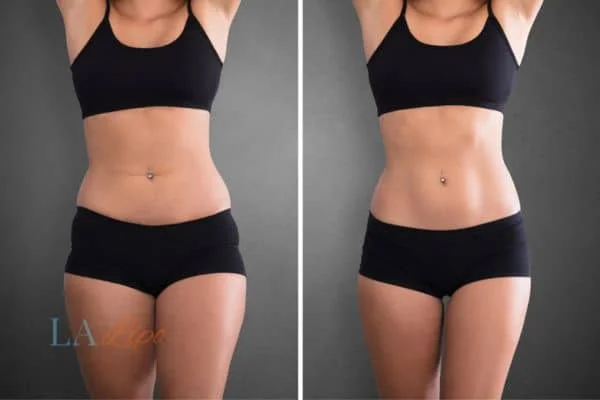 before and after results of non-surgical treatment to help a woman's body image and mental health Andover
