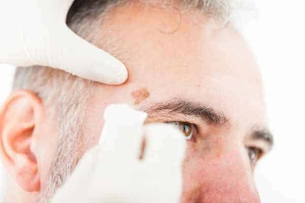 Age spots and elderly people Andover what is the link?