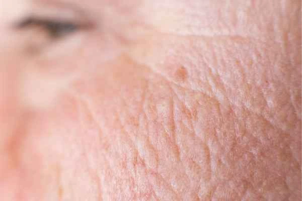 close up picture of a woman's face showing an age spot Andover