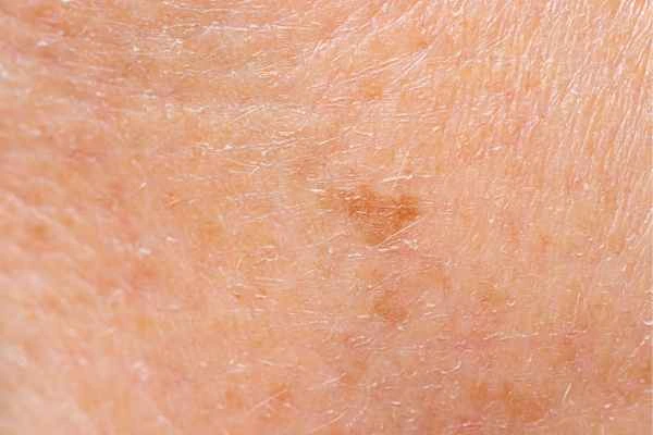 close up picture of age spots Andover