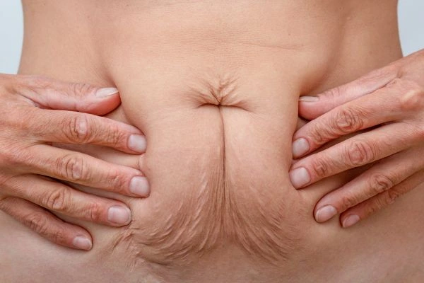 Image of a woman's stomach with loose skin - example of skin tightening Andover options