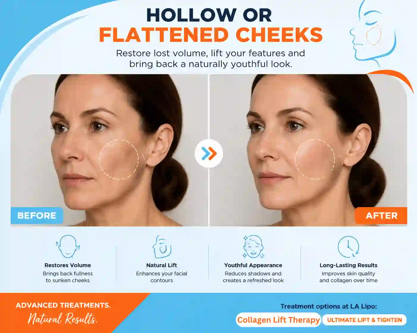 Sign #4: Hollow or Flattened Cheeks Andover