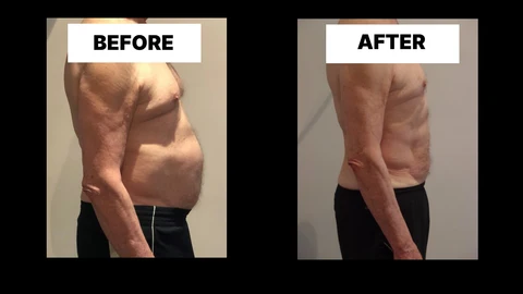 What Symptoms Can Diastasis Recti Cause in Men? Weak Core, Back Pain and Poor Posture Andover